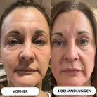 Natural Botulinum 8-Week Microinfusion System™