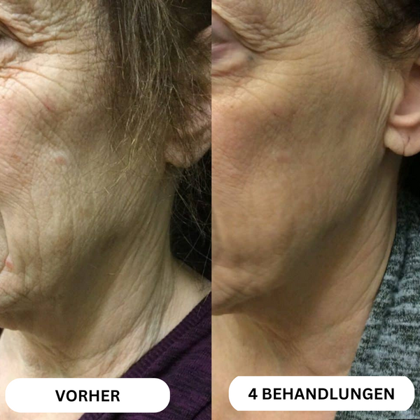 Natural Botulinum 8-Week Microinfusion System™