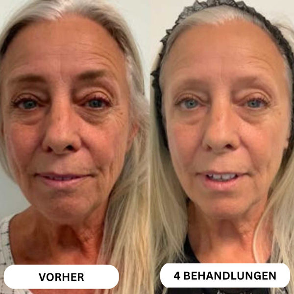 Natural Botulinum 8-Week Microinfusion System™